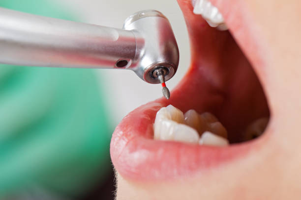 Best Emergency Tooth Extraction in Daleville, VA